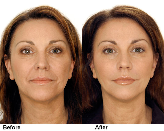 8 Point Facelift treatment at our Abu Dhabi clinic