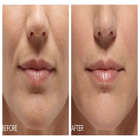 Belotero Fillers