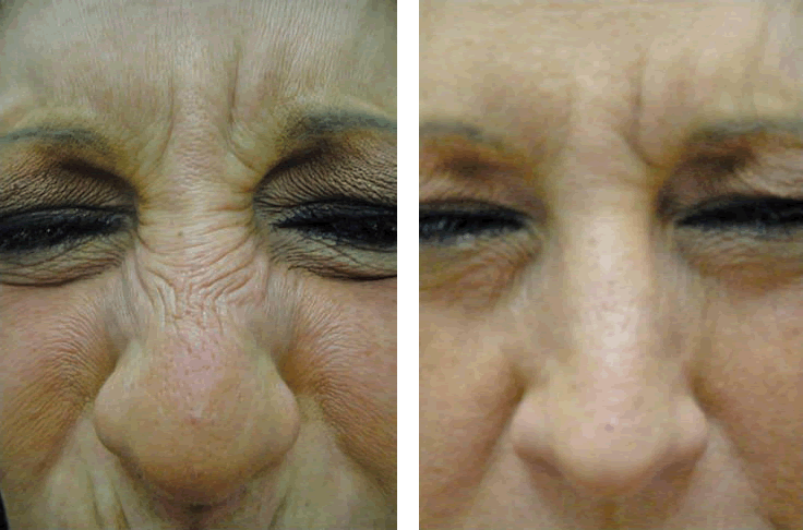 Botox For Nose Abu Dhabi