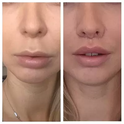 Bullhorn Lip Lift Abu Dhabi