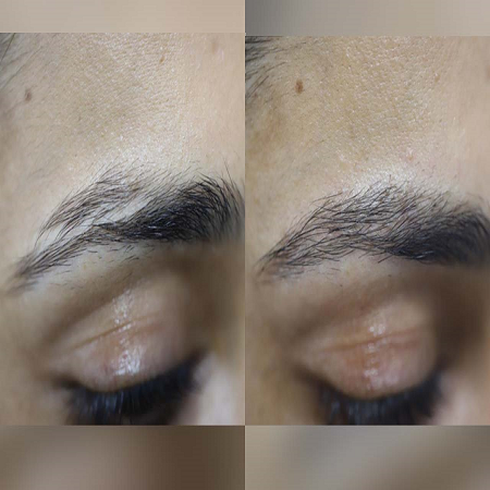 Eyebrow Hair Transplant Abu Dhabi