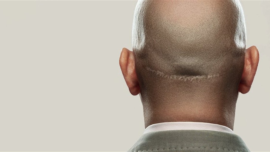 FUT Strip Hair Transplant Abu Dhabi