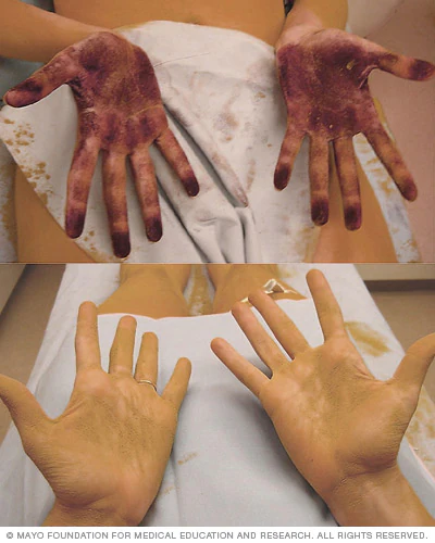 Hyperhidrosis Treatment Abu Dhabi