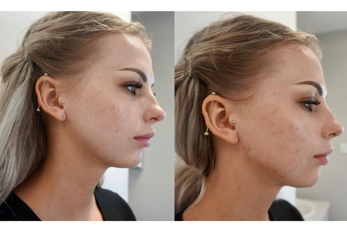 Best Jawline Contouring in Abu Dhabi UAE