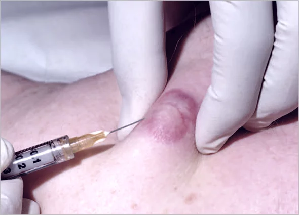 Keloid Treatment Abu Dhabi