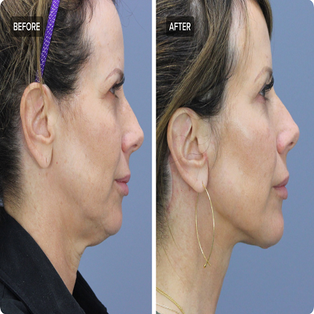 Neck Lift Surgery Abu Dhabi