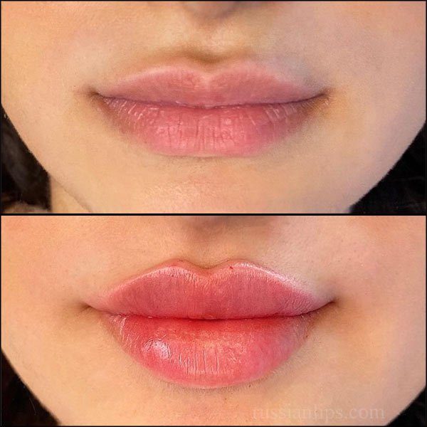 Russian Lip Fillers Abu Dhabi