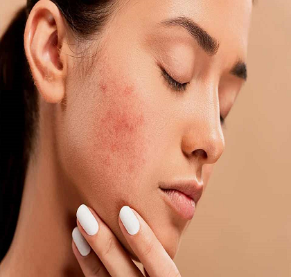 Acne Treatment Abu Dhabi