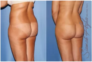 Body Jet Liposuction Abu Dhabi