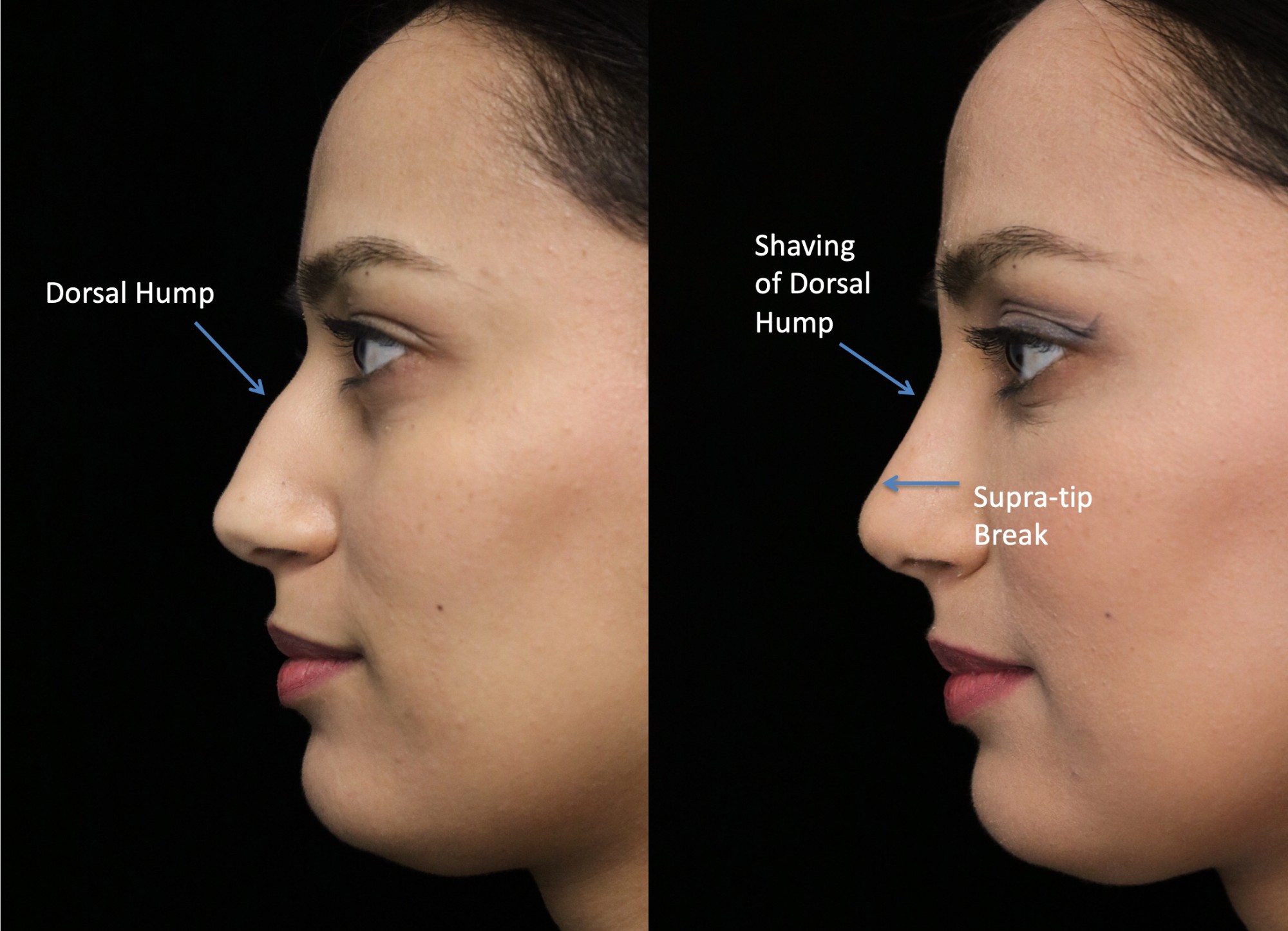 Closed Rhinoplasty Abu Dhabi