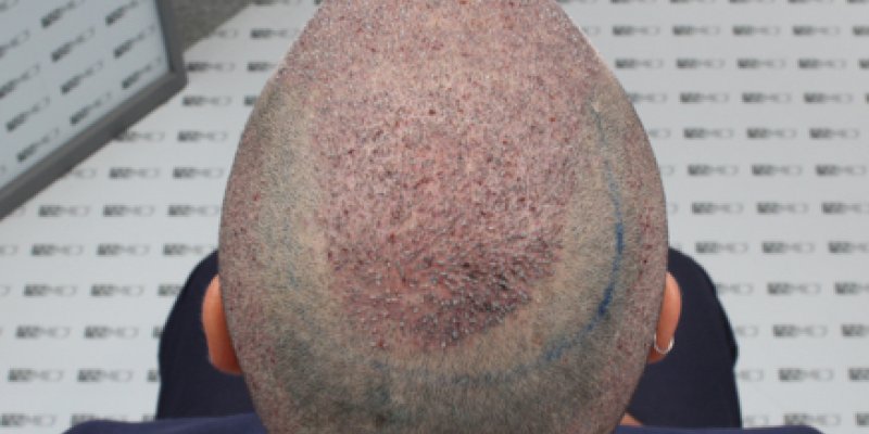 Crown Hair Transplant Abu Dhabi