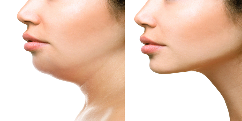 Double Chin Liposuction Abu Dhabi