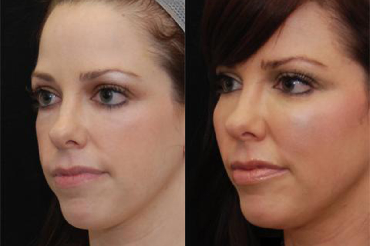 Best Fat Injections Fat Transfer Abu Dhabi