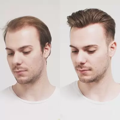 Hair Replacement Abu Dhabi