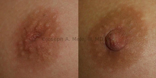 Inverted Nipple Surgery Abu Dhabi