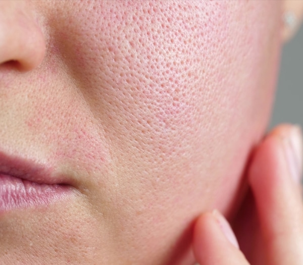 Large Pores Treatment Abu Dhabi