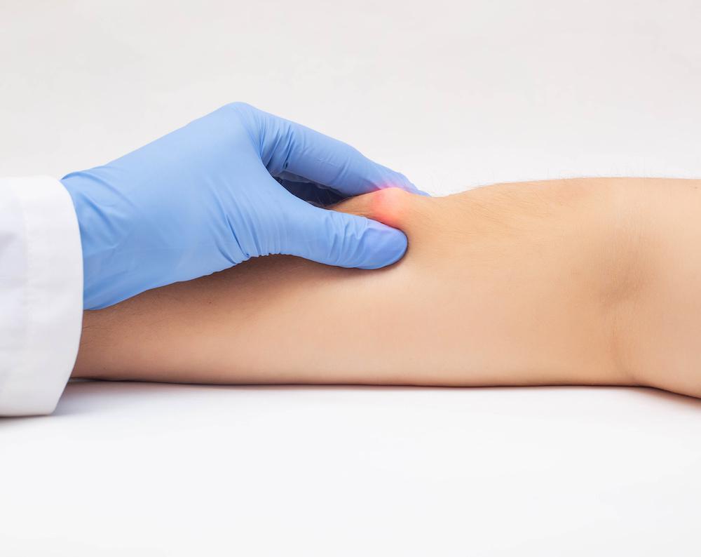 Lipoma Treatment Abu Dhabi