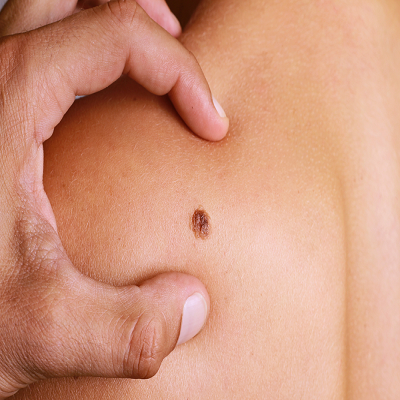 Benign Mole Removal Abu Dhabi