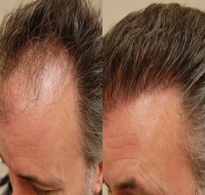Robotic Hair Transplant Abu Dhabi