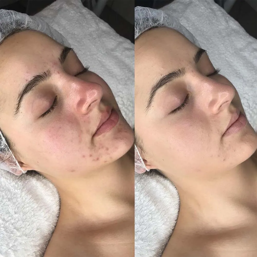 Salicylic Acid Peeling Abu Dhabi