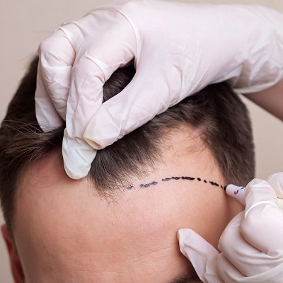 Scarless Hair Transplant Abu Dhabi