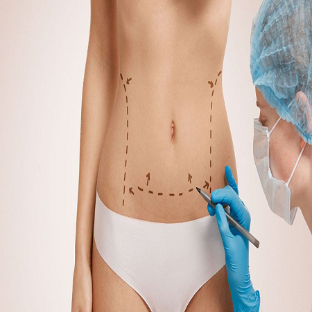 tummy tuck surgery abdominoplasty abu dhabi